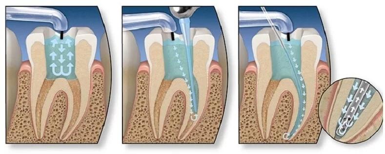 Lấy chỉ máu răng có đau không? Những điều cần biết khi lấy chỉ máu răng