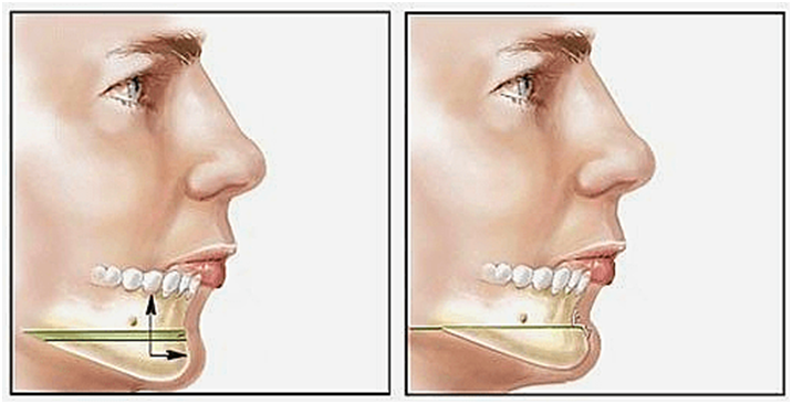 Tình trạng cằm lẹm là như thế nào? Cách trị cằm lẹm ra sao?