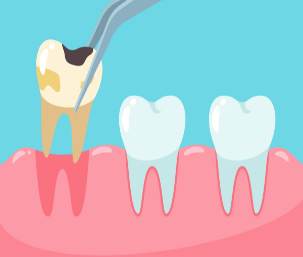 Thông thường nhổ răng số 4 bao lâu thì lành? Chăm sóc răng miệng khi mới nhổ răng