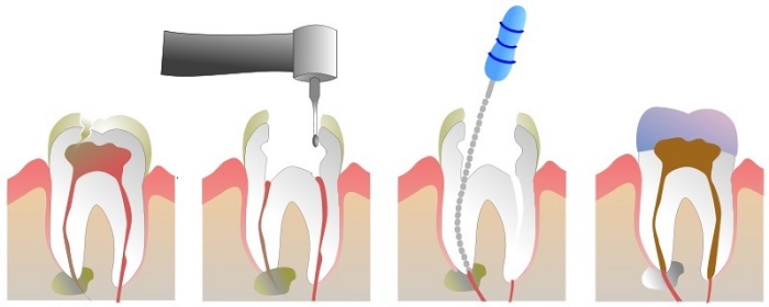 Lấy chỉ máu răng có đau không? Những điều cần biết khi lấy chỉ máu răng