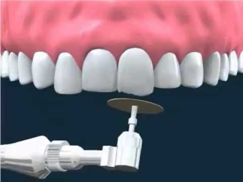 Tại sao phải mài răng ngắn lại? mài răng ngắn lại có tác dụng gì?