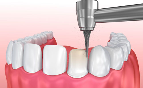 Tại sao phải mài răng ngắn lại? mài răng ngắn lại có tác dụng gì?