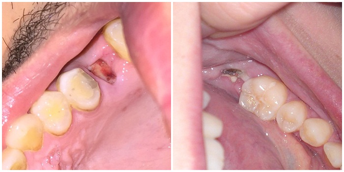 Nhổ răng còn sót chân răng có sao không?