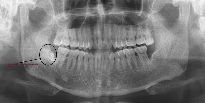 Nhổ răng còn sót chân răng có sao không?