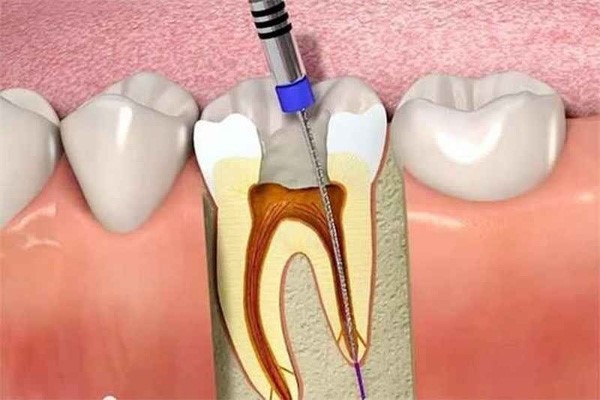 Lấy chỉ máu răng có đau không? Những điều cần biết khi lấy chỉ máu răng