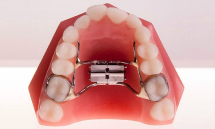 Các khí cụ niềng răng là gì? Tìm hiểu về các khí cụ niềng răng