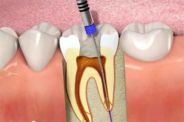 Khi lấy tủy răng số 7 bao nhiêu tiền? Cập nhật bảng giá lấy tuỷ răng số 7