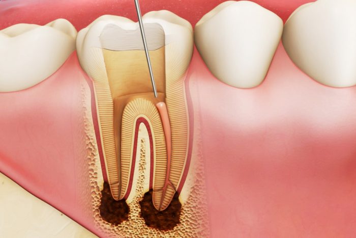 Khi lấy tủy răng số 7 bao nhiêu tiền? Cập nhật bảng giá lấy tuỷ răng số 7