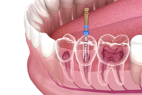 Những cách trị viêm tủy răng tại nhà đơn giản