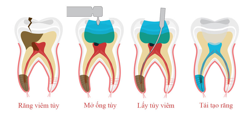 Khi lấy tủy răng số 7 bao nhiêu tiền? Cập nhật bảng giá lấy tuỷ răng số 7