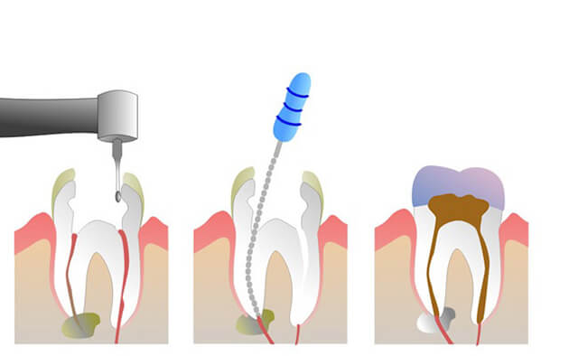 Những cách trị viêm tủy răng tại nhà đơn giản