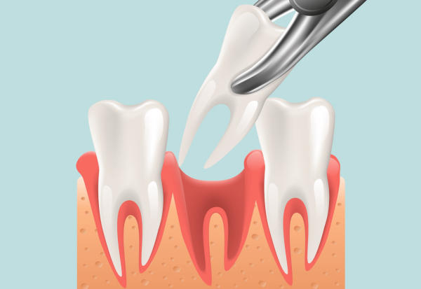 Những mẹo cầm máu sau khi nhổ răng bạn nên biết