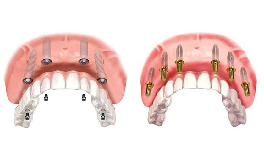 Những lợi ích khi trồng răng implant On All 4