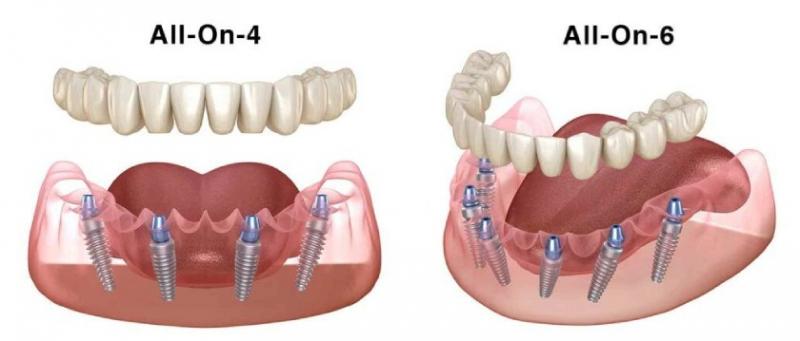 Những lợi ích khi trồng răng implant On All 4