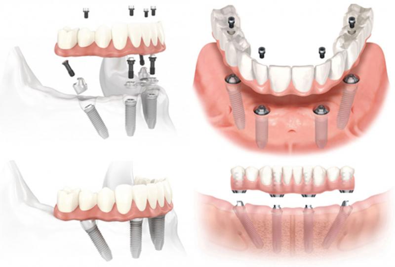 Những lợi ích khi trồng răng implant On All 4