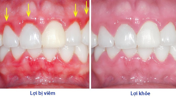 Dấu hiệu nhận biết viêm lợi và cách điều trị viêm lợi