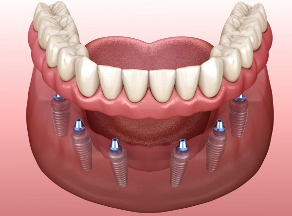 Những lợi ích khi trồng răng implant On All 4