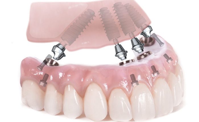 Những lợi ích khi trồng răng implant On All 4