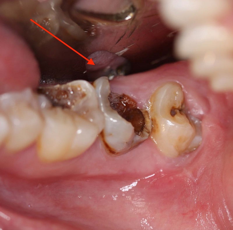 Nguyên nhân dẫn đến sâu răng và cách chữa sâu răng