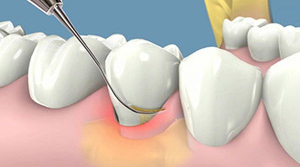 Tìm hiểu về cao răng là gì?