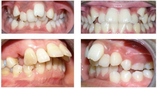 Tại sao lại bị răng vẩu? Răng vẩu có chữa được không?