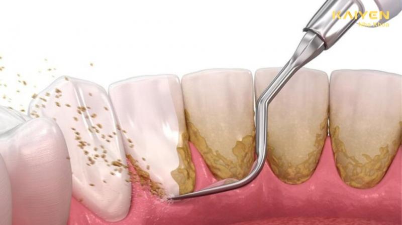 Tìm hiểu về cao răng là gì?